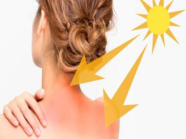 Tại sao cần tránh cháy nắng khi đi biển?